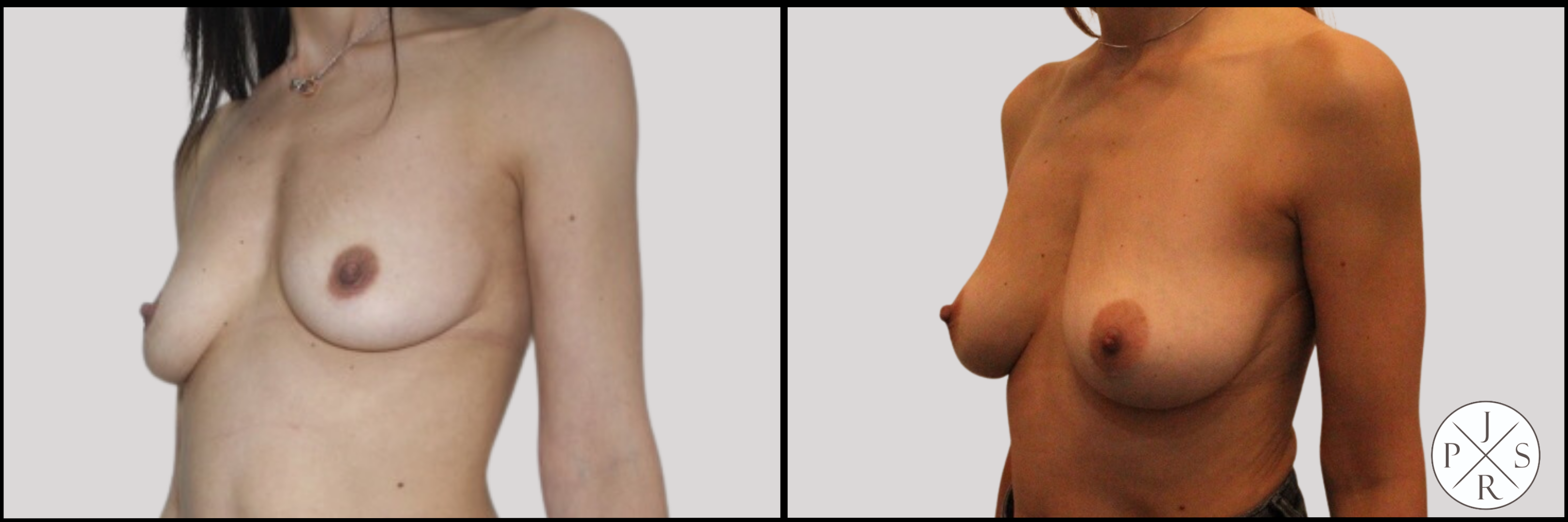 Fat Transfer Breast Augmentation Before & After Image